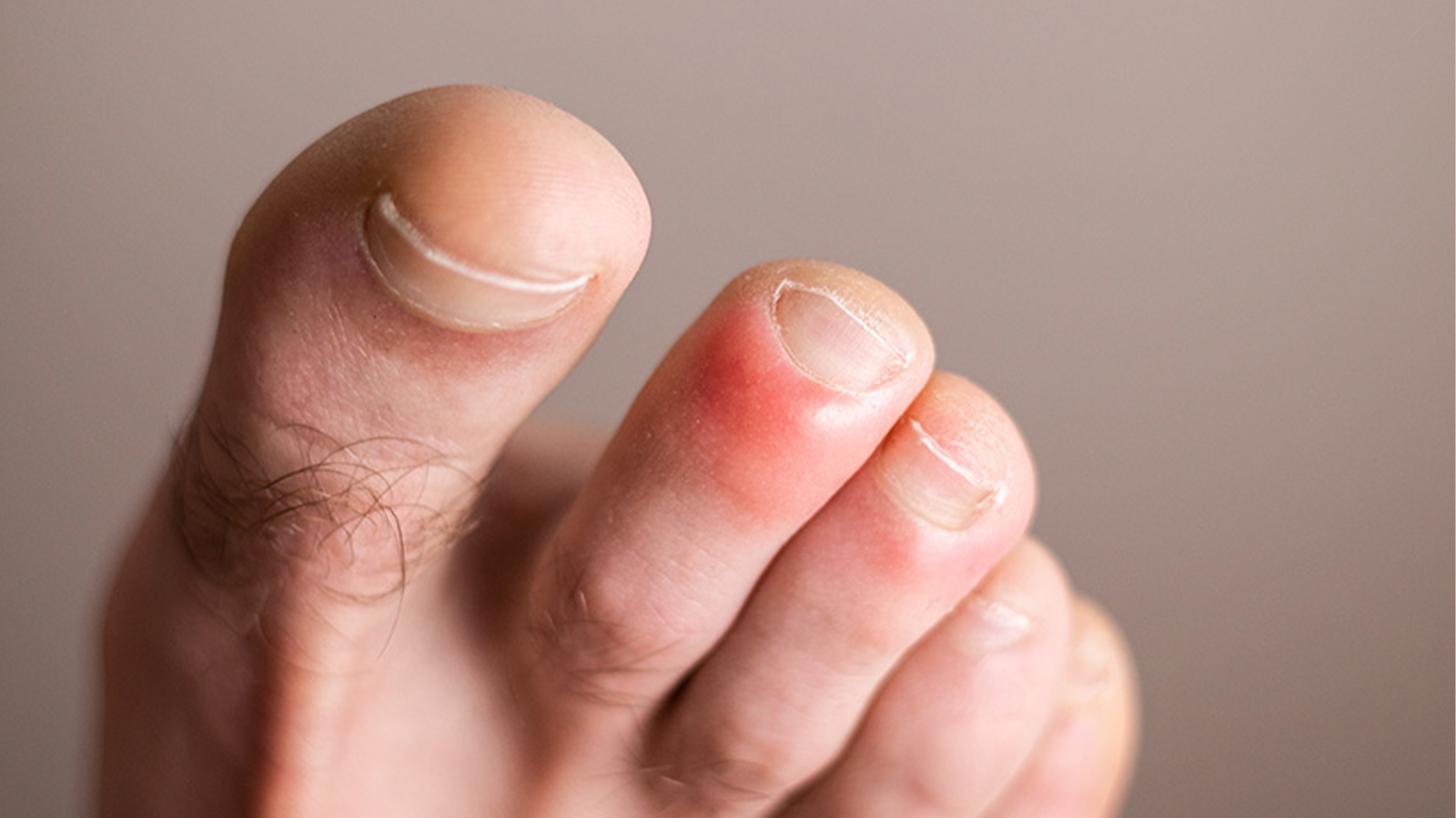 What exactly are chilblains?