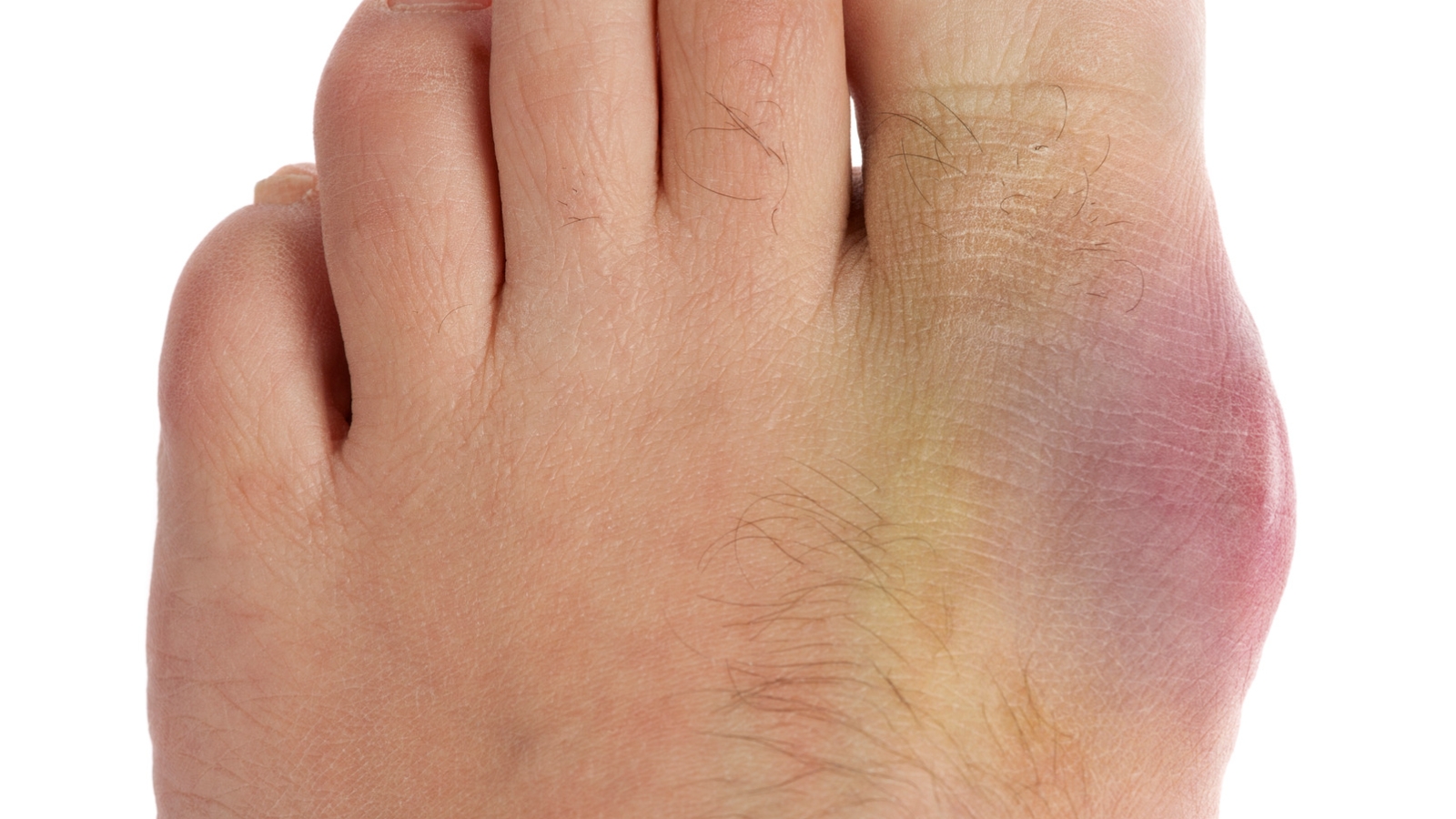 What does gout do to the feet?