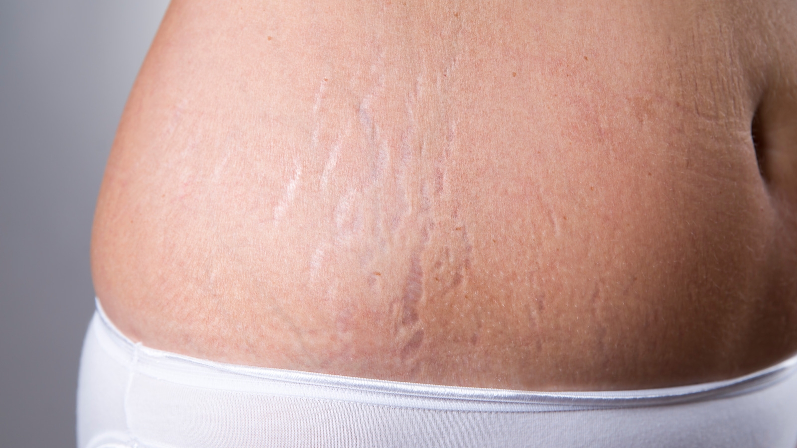 What causes stretch marks?