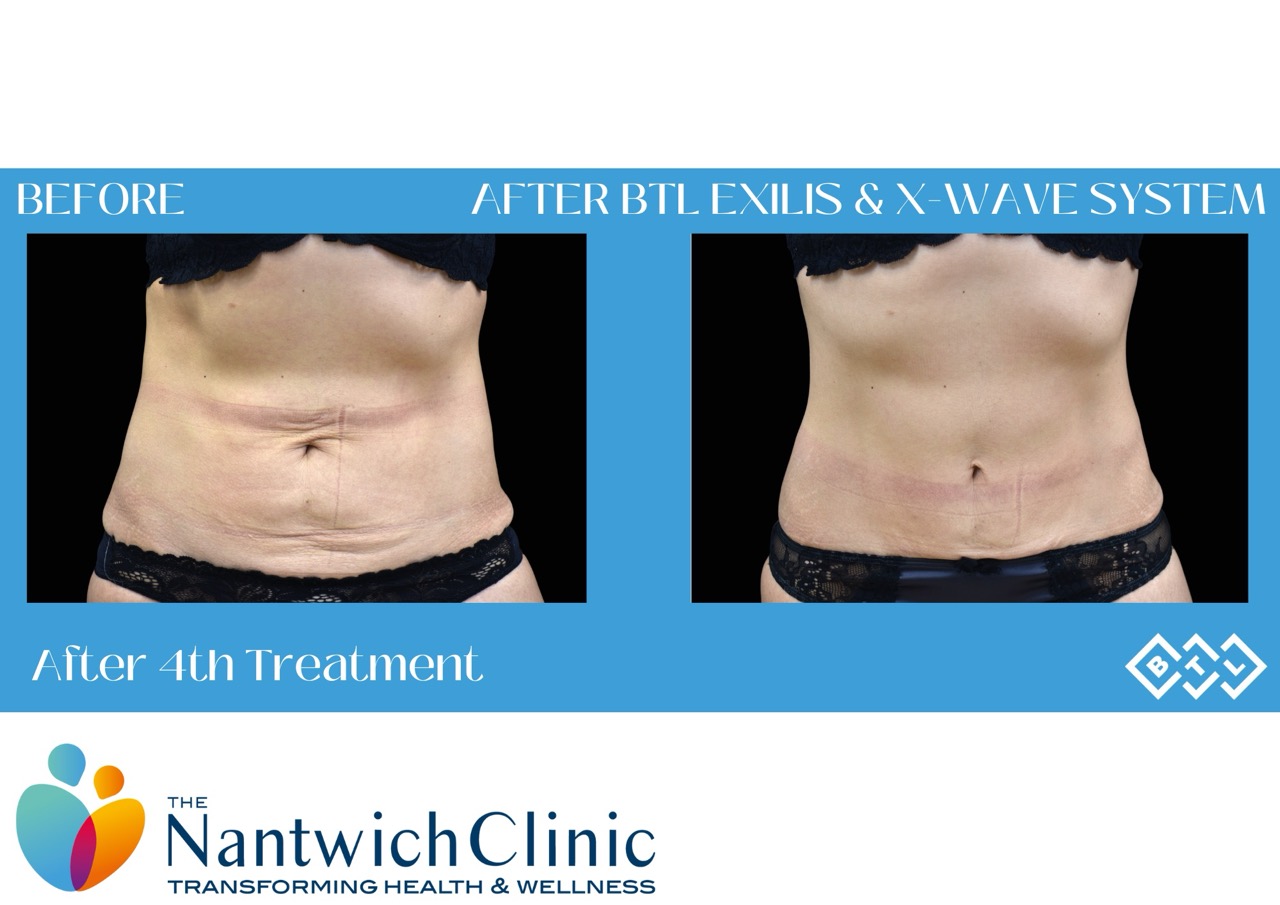 BEFORE & AFTER ipl 3 - 55