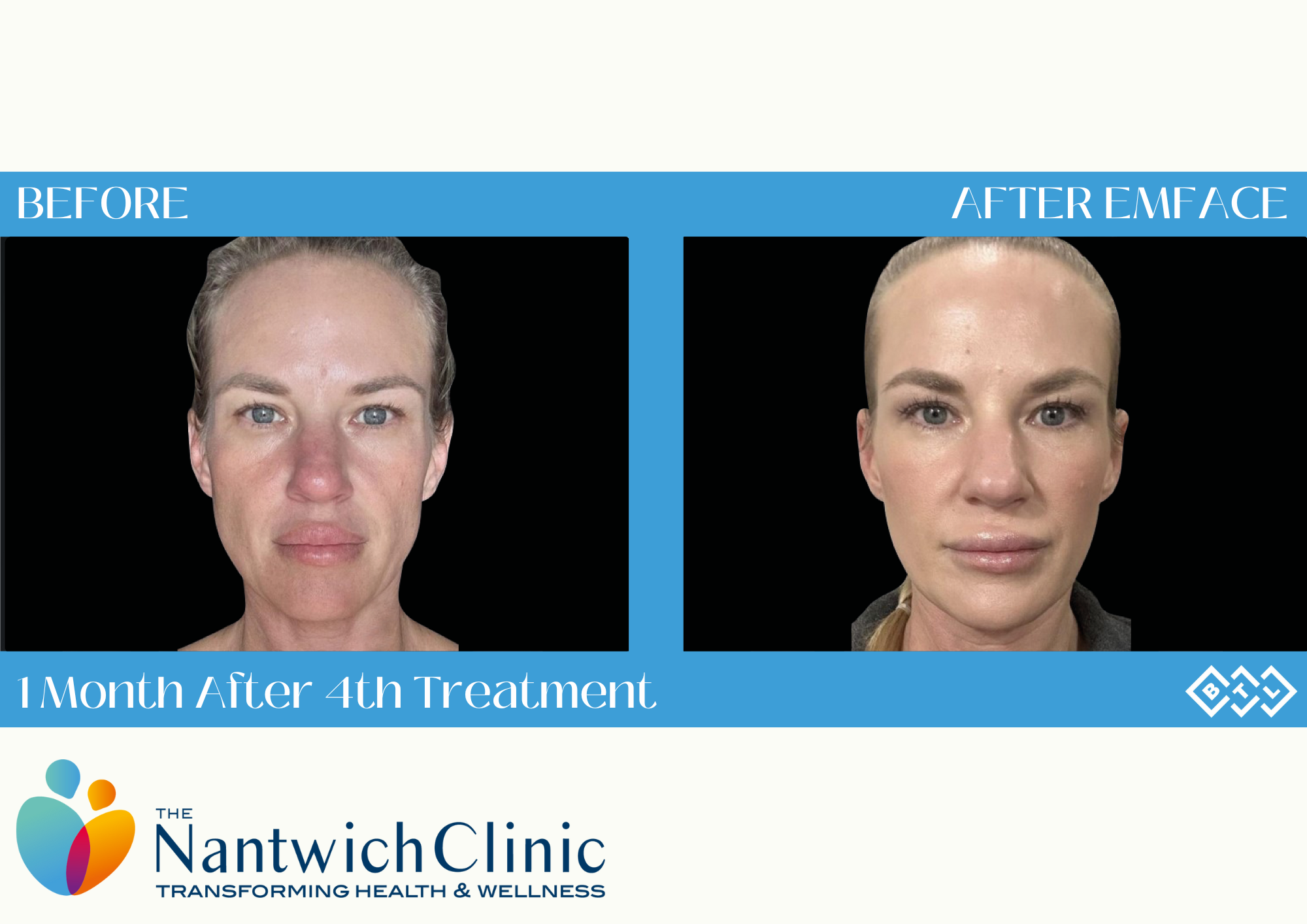 before-and-after-emface