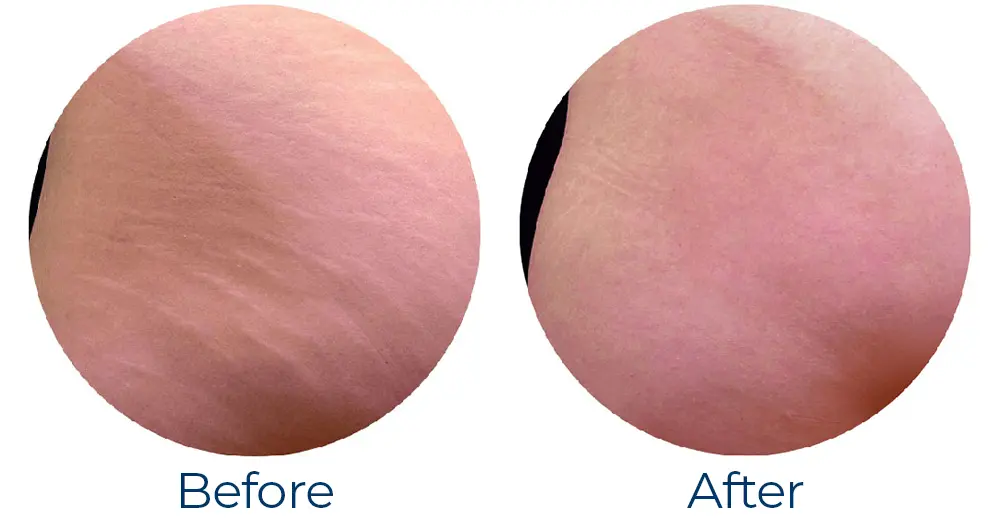 stretchmarksbeforeafter